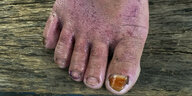Ein Fuß mit Hautreizungen