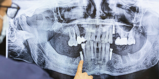 A dentist analyzes an x-ray of a series of teeth.