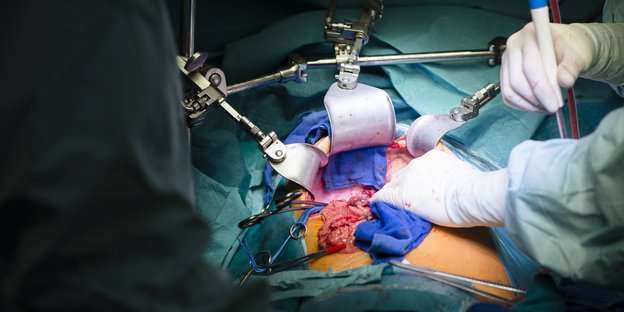 Transplantationsvorgang - Hände mit Medizinbesteck über einem geöffneten Körper