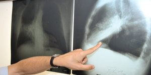 Jemand zeigt mit dem Finger auf ein Röntgenbild