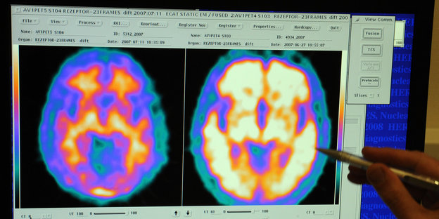 Magnetresonanztomografie (MRT): zwei Gehirne im Vergleich , ein Alzheimer-Patient (r) und ein gesunder Proband