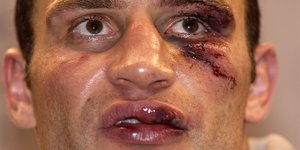 Vitali Klitschko mit großer Wunde in Gesicht