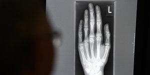 Jemand betrachtet das Röntgenbild einer Hand.