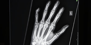 Eine Röntgenaufnahme einer Hand