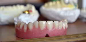 Drei Zahnabgüsse liegen auf einem Tisch