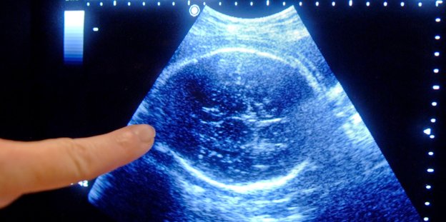 Ein Finger zeigt auf ein Ultraschallbild eines Ungeborenen