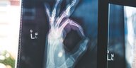 Auf einer Röntgenaufnahme machen Finger ein "OK"-Zeichen