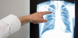 Arzt zeigt auf das Röntgenbild
