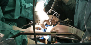 Transplantationsmediziner entnehmen einem Lebendspender eine Niere