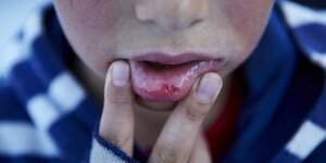 Kind zeigt aufgerissene Lippe von innen