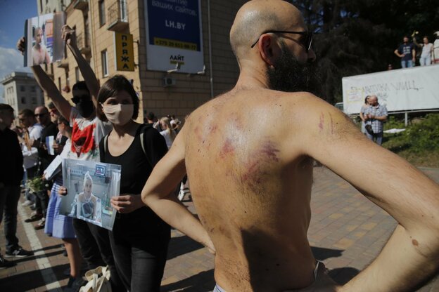 Ein in einem Gefängnis gefolterter Mann zeigt auf der Straße mit nacktem Oberkörper seine Foltermale