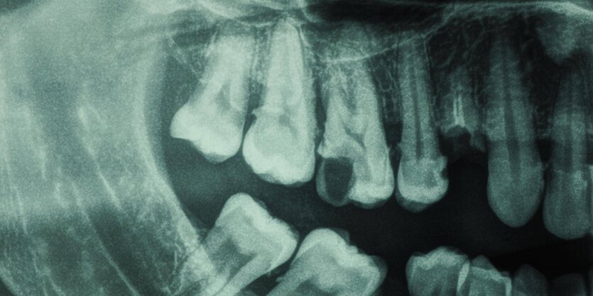 Röntgenaufnahme eines Gebisses