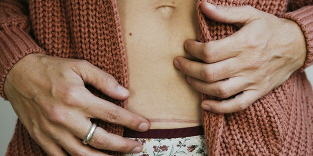 Eine Frau zeigt ihre Kaiserschnitt-Narbe