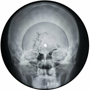Röntgenbild eines Schädels, rund wie eine Schallplatte, mit Loch in der Mitte