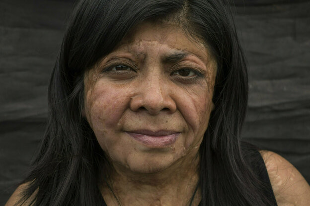 Eine dunkelhaarige Frau mit stark vernarbtem Gesicht