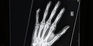 Röntgenbild einer linken Hand