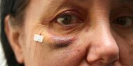 Ein blau geschlagenes verletztes Auge einer Frau