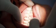 Aufgerissener Mund, Zähne werden von Arzt kontrolliert
