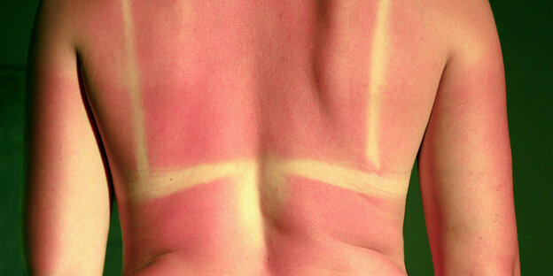 Spuren eines Bikinioberteils auf der Haut einer Person mit Sonnenbrand.