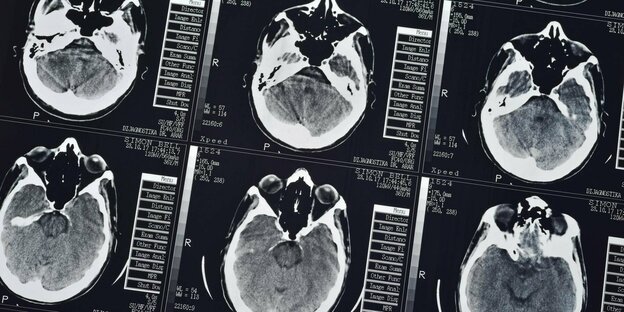 tomografische Aufnahmen eines Gehirns