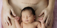 Eine Frau mit großer Kaiserschnittnarbe liegt nackt und hält ein Baby , das auf ihr liegt, an den Händchen