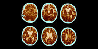 Scan eines Gehirns der die Entwicklung der Alzheimer-Krankheit zeigt