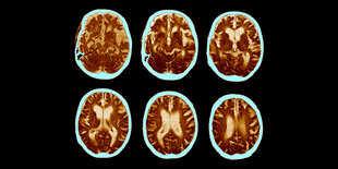 Scan eines Gehirns der die Entwicklung der Alzheimer-Krankheit zeigt