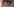 Frau mit Bluterguß unter dem Auge