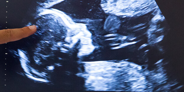Ein Finger zeigt auf ein Ultraschall-Bild