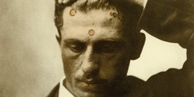 historische Aufnahme, Syphilis-Flecken auf der der Stirn eines jungen Mannes