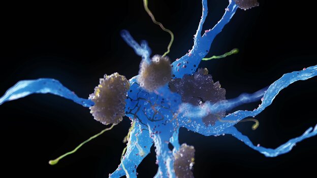 Nervenzelle eines Alzheimerpatienten