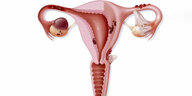 Zeichnung einer Gebärmutter mit Endometriose