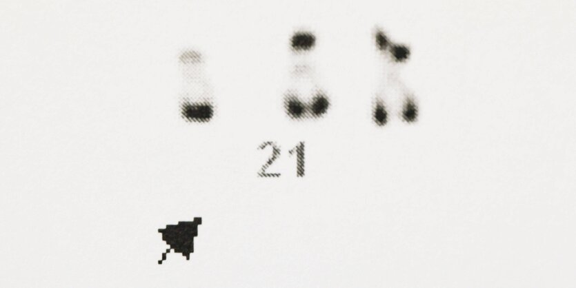 Chromosomen eines Menschen mit Down Syndrom