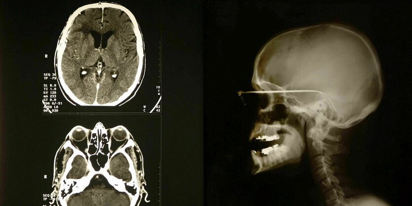 Röntgenbild des Schädels
