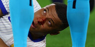 Kylian Mbappé mit blutiger Nase auf den Rasen liegend