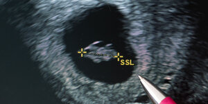 Das Ultraschallbild eines Fötus.
