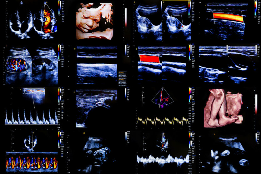 Eine Zusammenstellung von hochmodernen, farbigen Ultraschallbildern des Bauches einer schwangeren Frau