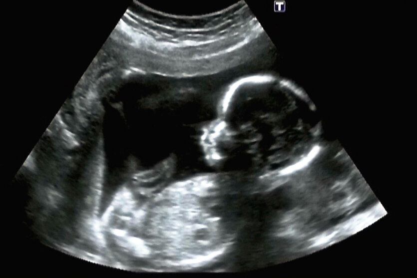 Ultraschallbild eines Fötus im 4. Monat