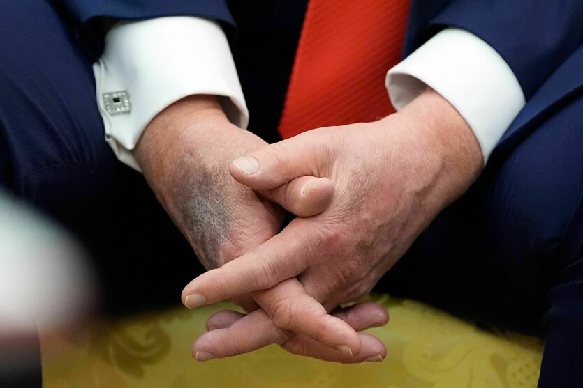 Trumps ineinander verschränkte Hände, auf der rechten ein Fleck