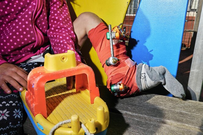 Ein Kind mit einer Fixierung am Bein beim Spielen.