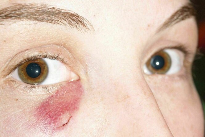 Eine Person mit einer Verletzung unter dem Auge