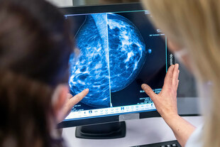 Zwei Ärztinnen diskutieren mammographische Aufnahmen, die auf einem Computerscreen aufscheinen