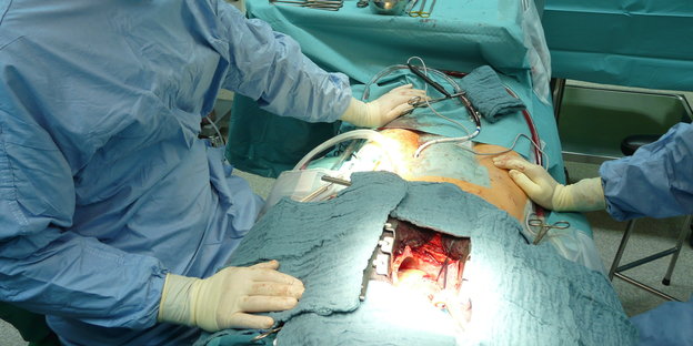 Ein Patient auf dem OP-Tisch mit geöffnetem Brustkorb, auf beiden Seiten sitzen Ärzte
