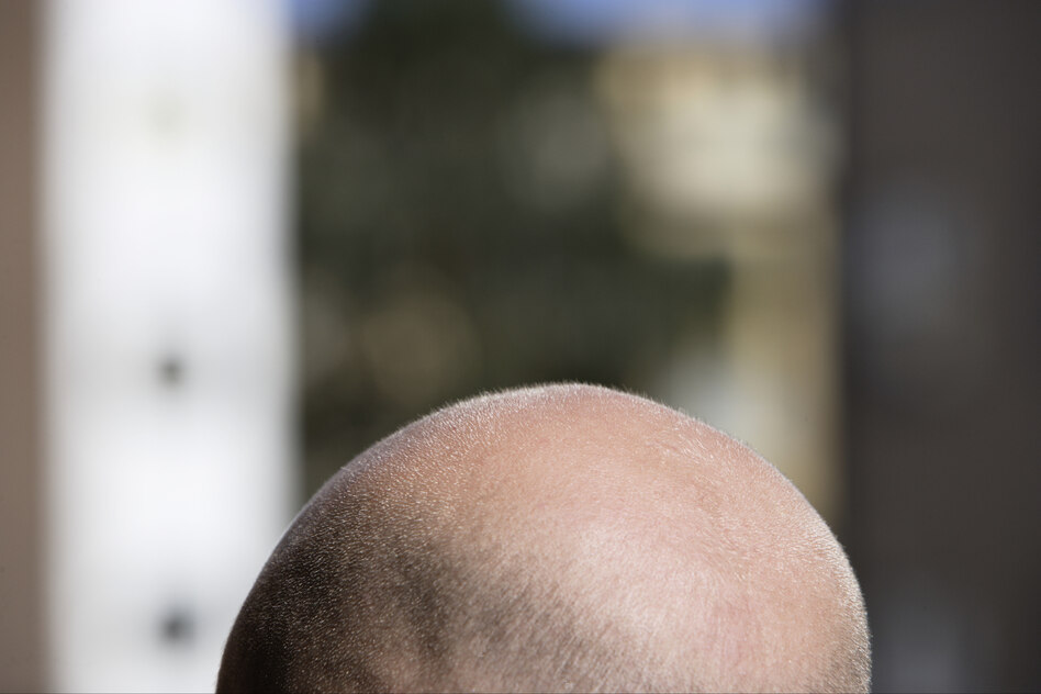Das Problem mit dem Haarausfall: Meine Platte